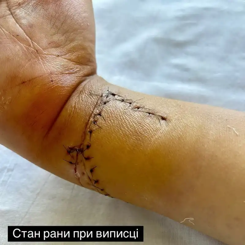 У Вінниці лікарі відновили рух пальців підлітку після складного поранення склом У Вінниці лікарі відновили рух пальців підлітку після складного поранення склом